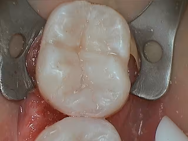 Chris 19 Amalgam Replacement After