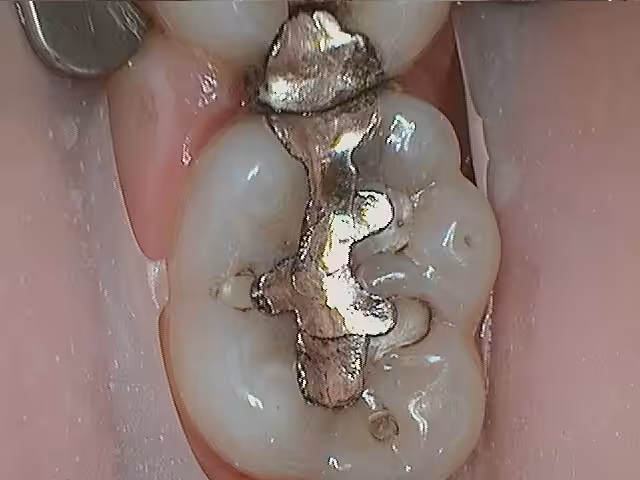 Chris 19 Amalgam Replacement Before