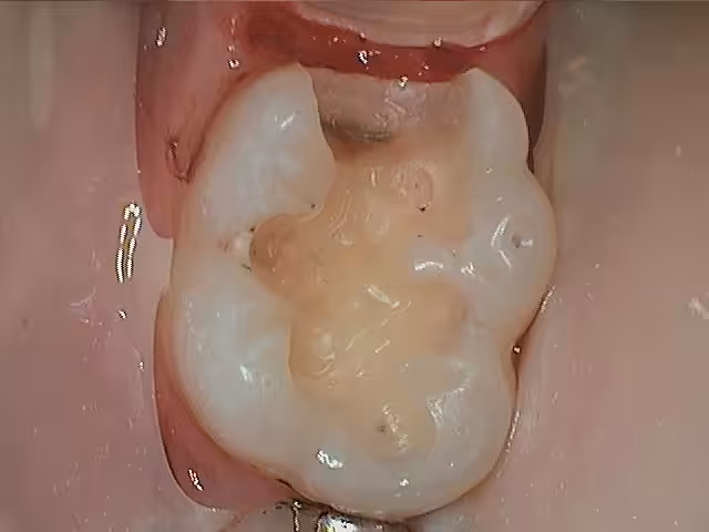 Chris 19 Amalgam Replacement During
