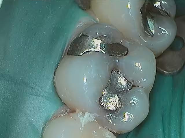 David 2failing Amalgams Before Photo2