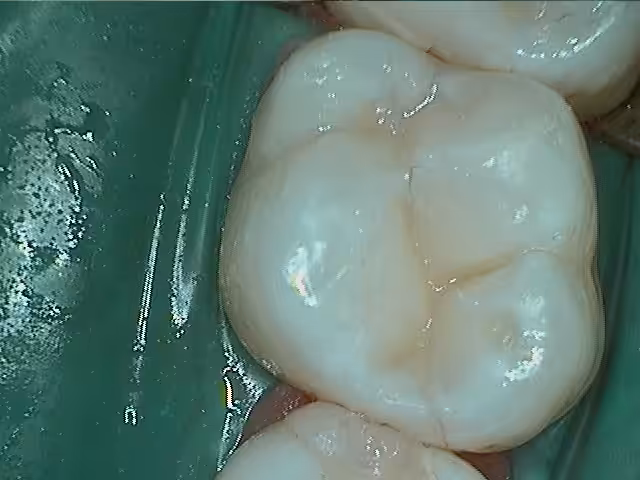 David 2failing Amalgams After Photo2