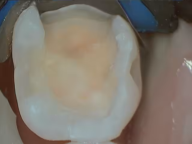 Jacobsen 19 Failing Composite During1