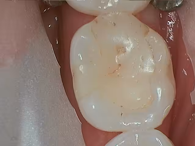 Jacobsen 19 Failing Composite Before1