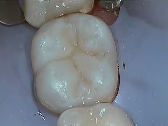 Mark Failing Amalgams After Photo1