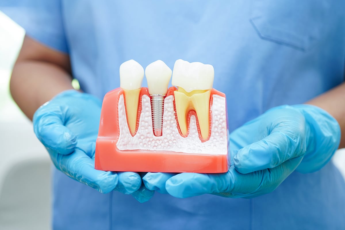 What To Expect During Dental Implant Recovery Blog